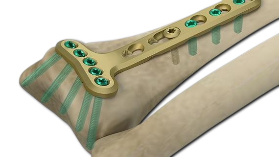 Hero Implant